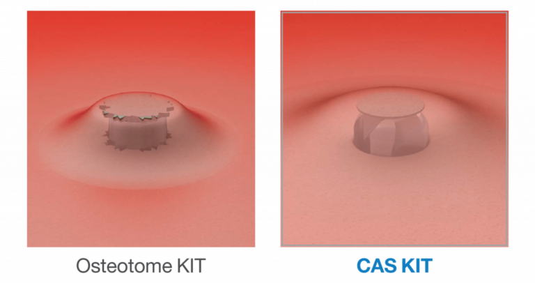 Crestal Approach Sinus Kit | CAS Kit - Osstem Implant